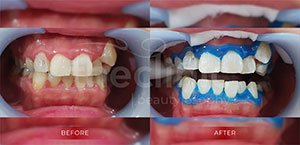 Teeth Whitening